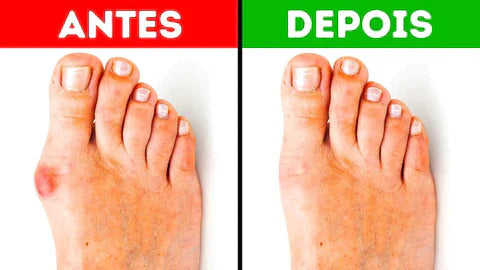 Meia Ortopédica - Corretor de Joanete (COMPRE 1 LEVE 2)